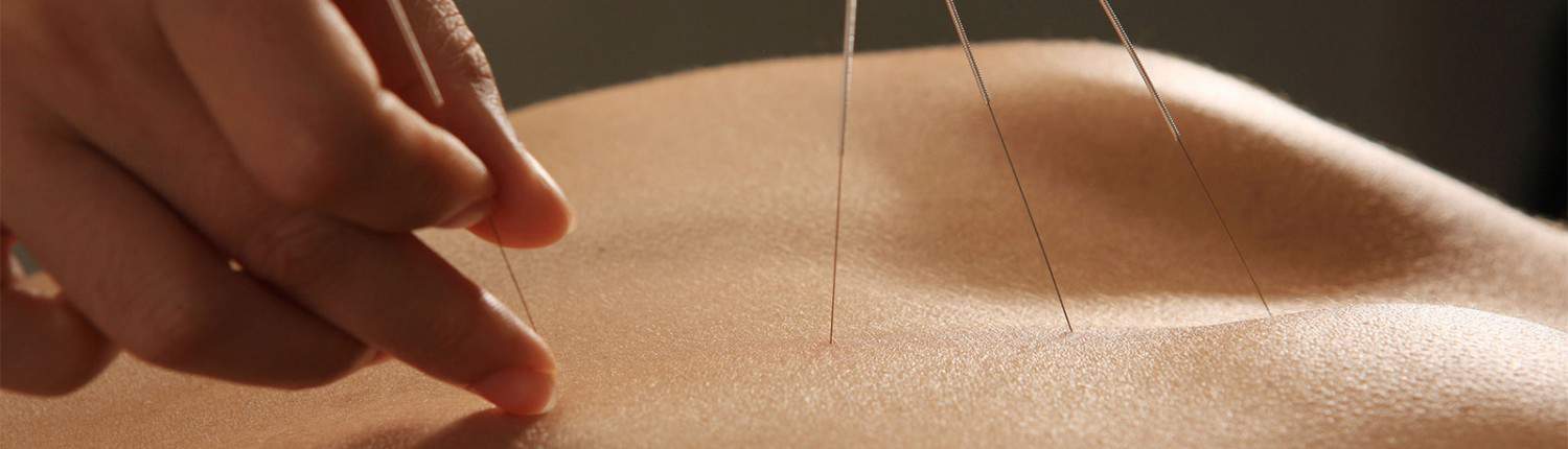 acupuncture photo